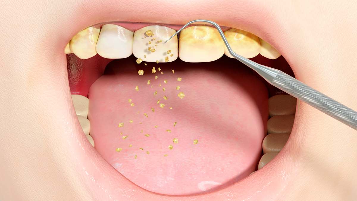 Comment éliminer le tartre de vos dents naturellement à la maison : le remède le plus efficace
